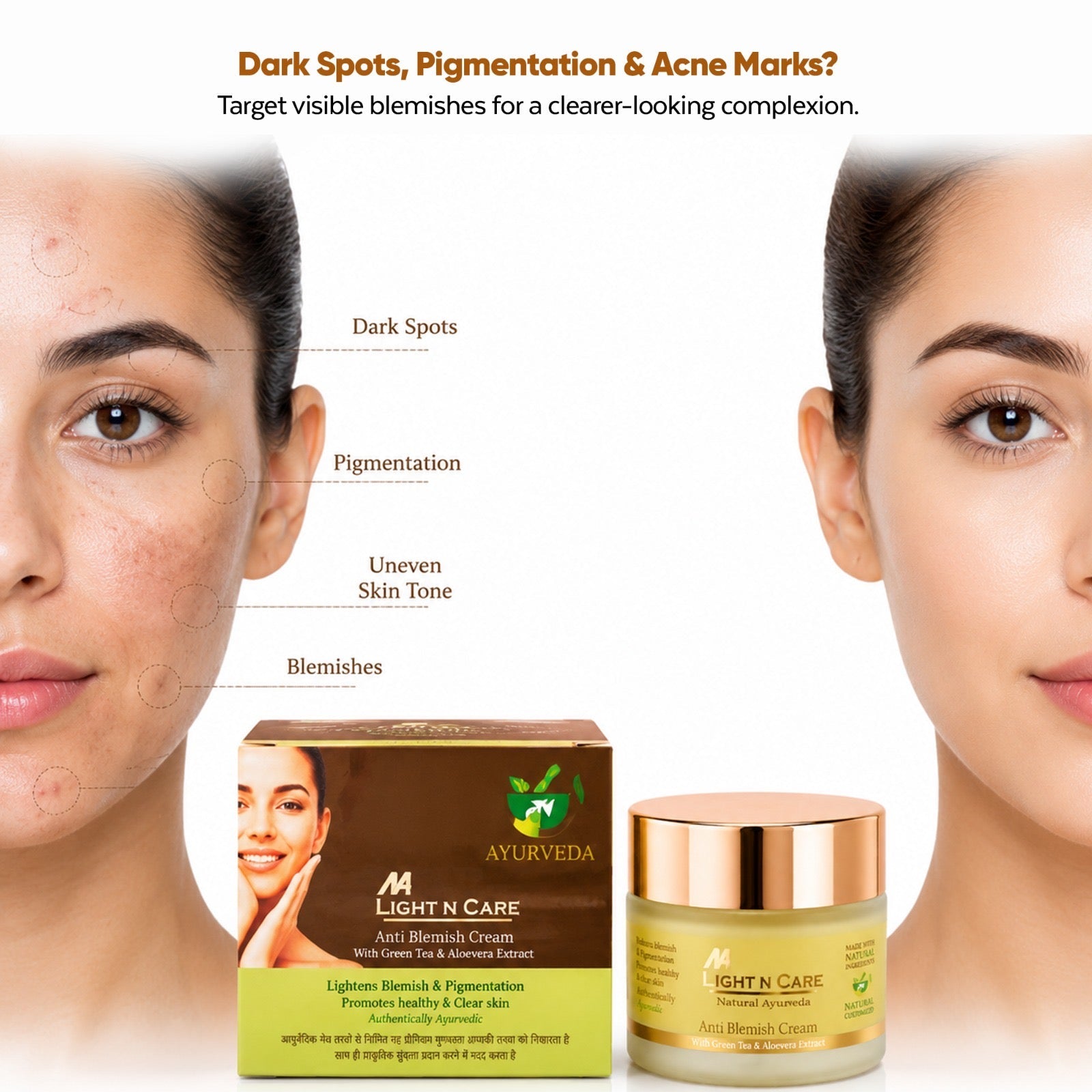 Light N Care Anti Blemish Cream – Ayurvedic Formula with Green Tea & Aloe Vera Extract (50g) - Natural Ayurveda